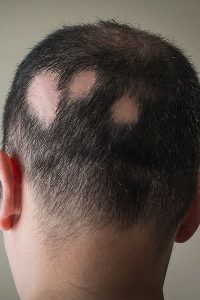 Man's head with multiple bald spots on his head - Feathair