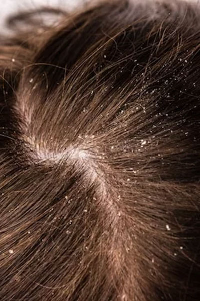 Dandruff showing on scalp - Feathair