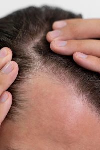 Man experiencing hair loss with hair thinning - Feathair