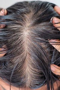 Person showing their oily scalp - Feathair
