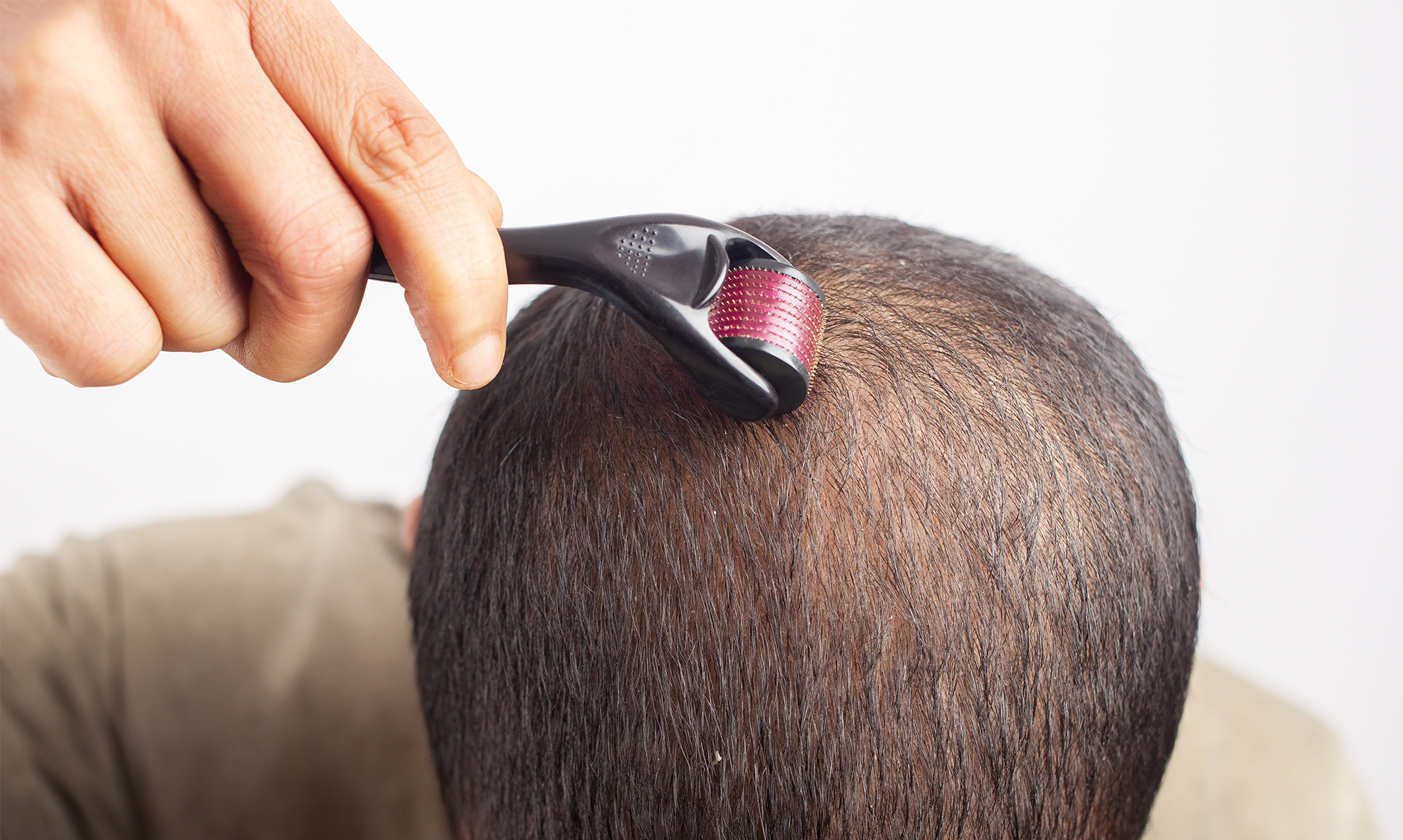 Person doing derma rolling for hair treatment - Feathair