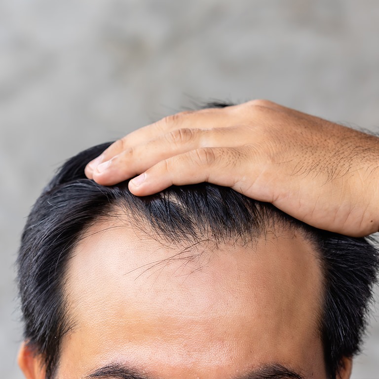 How To Take Care After A Hair Transplant